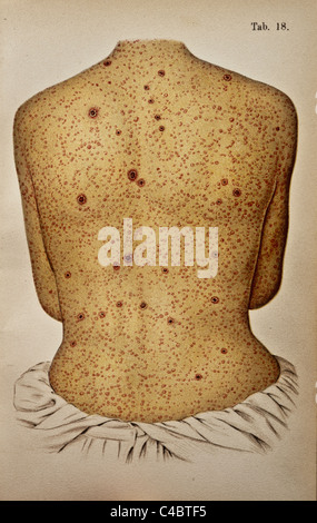 Illustration de papules syphilitiques sur la peau humaine Banque D'Images