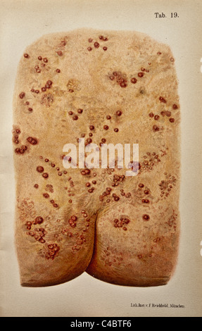 Illustration de papules syphilitiques sur la peau humaine copyright 1898 Banque D'Images