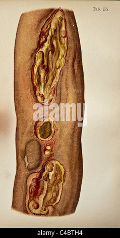 Illustration des ulcères syphilitiques sur la peau humaine copyright 1898 Banque D'Images