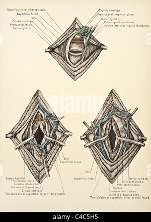 Illustration de l'Larynx copyright 1904 Banque D'Images