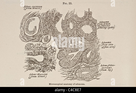 Illustration de l'anatomie microscopique de circa 1881 adénome Banque D'Images