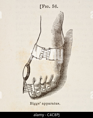 Illustration médicale antique d'affection des ongles circa 1881 Banque D'Images