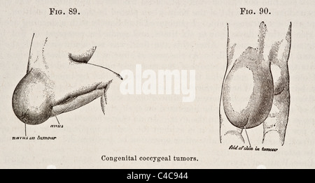 Illustration médicale antique de sacré et coccygien circa 1881 Tumeurs Banque D'Images