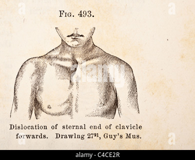 Illustration médicale antique de dislocation de l'omoplate et la clavicule. Banque D'Images