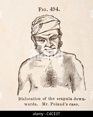 Illustration médicale antique de dislocation de l'omoplate et la clavicule. Banque D'Images