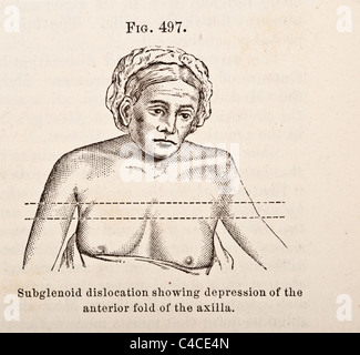 Illustration médicale antique dépeignant une luxation de l'humérus Banque D'Images