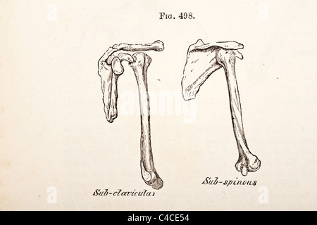 Illustration médicale antique dépeignant une luxation de l'humérus Banque D'Images