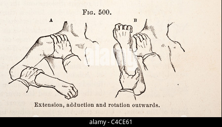 Illustration médicale antique dépeignant une luxation de l'humérus Banque D'Images