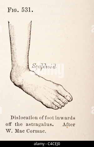 Illustration médicale antique montrant la dislocation du pied Banque D'Images