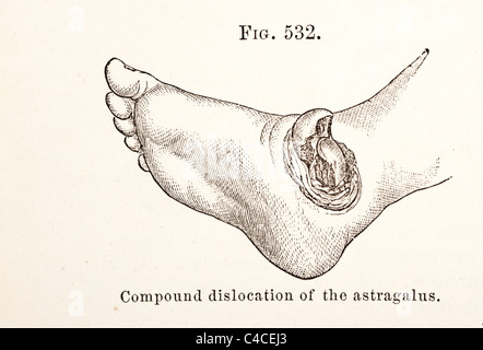 Illustration médicale antique montrant la dislocation du pied Banque D'Images