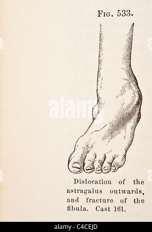 Illustration médicale antique montrant la dislocation du pied Banque D'Images