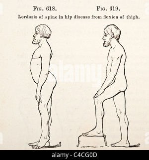 Illustration médicale antique d'Hip-Joint vers la maladie de la hanche 1881 Banque D'Images