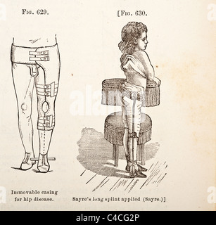 Illustration médicale antique de traitement pour maladie Hip-Joint Banque D'Images