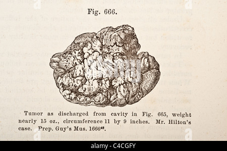 Illustration médicale antique des tumeurs de l'os vers 1881 Banque D'Images