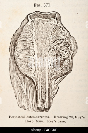 Illustration médicale antique des tumeurs de l'os vers 1881 Banque D'Images