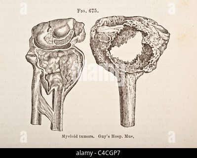 Illustration médicale antique des tumeurs de l'os vers 1881 Banque D'Images