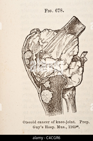 Illustration médicale antique des tumeurs de l'os vers 1881 Banque D'Images