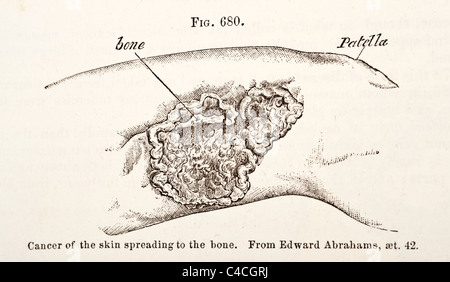 Illustration médicale antique des tumeurs de l'os vers 1881 Banque D'Images