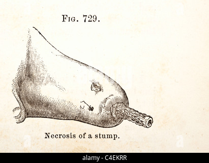 Illustration noir et blanc de la nécrose d'un moignon de jambe, copyright 1881 Banque D'Images