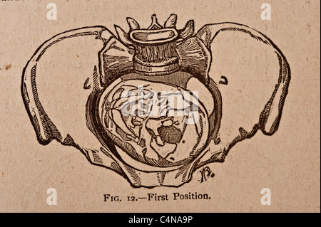 Illustration médicale antique d'un os du bassin Banque D'Images