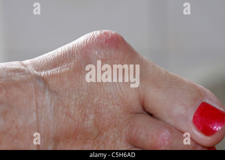 L'hallux valgus et oignon Banque D'Images