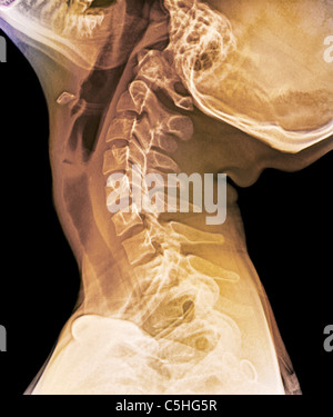 Extension normale du cou, X-ray Banque D'Images