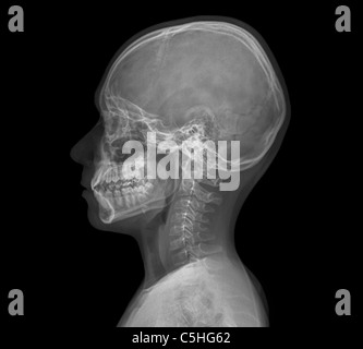 Tête de l'enfant normal, X-ray Banque D'Images