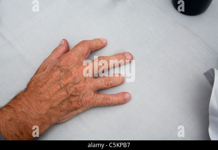 Un homme de main droite sur une toile cirée close-up, pointe de troisième doigt manquant Banque D'Images