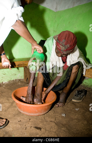 Patient avec podoconiosis ayant ses pieds et jambes mesurée en Ethiopi Banque D'Images