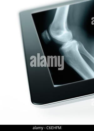 Studio shot of digital tablet with x-ray de genou humain Banque D'Images