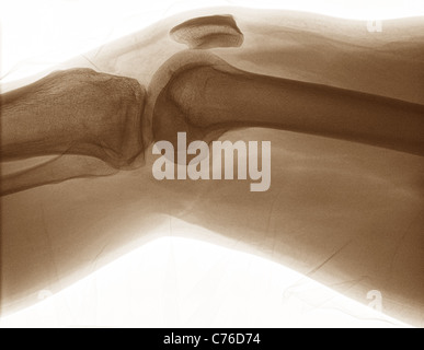 L'opération pour réparer une fracture de l'articulation du genou (voir également x-ray images de vis et goupilles de plaques) Banque D'Images