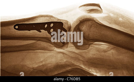 L'opération pour réparer une fracture de l'articulation du genou (voir également x-ray images de vis et goupilles de plaques) Banque D'Images