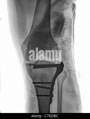 L'opération pour réparer une fracture de l'articulation du genou (voir également x-ray images de vis et goupilles de plaques) Banque D'Images