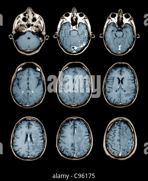 Le fonctionnement normal du cerveau, d'IRM Banque D'Images
