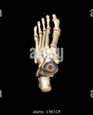Pied normal. 3D couleur tomodensitométrie (TDM) du pied en bonne santé d'un patient de 23 ans. Banque D'Images
