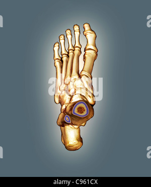 Pied normal. 3D couleur tomodensitométrie (TDM) du pied en bonne santé d'un patient de 23 ans. Banque D'Images