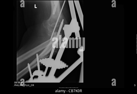 X-ray montrant metal d'insérée pour fixer une fracture multiple dans le bras Banque D'Images