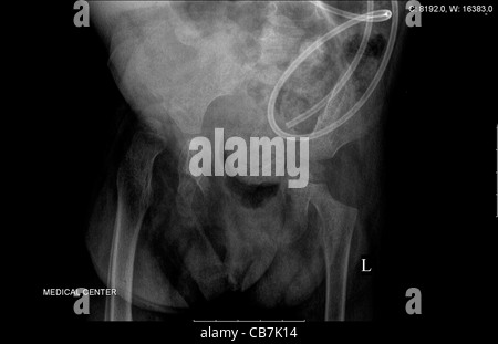 Radiographie d'un enfant de 3 ans avec un talon fracture du tibia et du péroné Banque D'Images