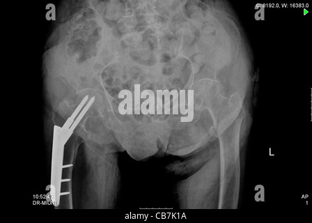 X-ray d'une patiente âgée de 93 ans après l'infarctus aigu du myocarde (IAM), Banque D'Images