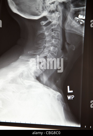 Close-up d'une radiographie d'un cou humain Banque D'Images