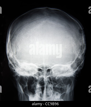 X-Ray photo de base du crâne Banque D'Images