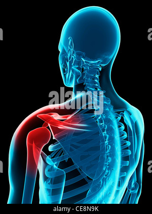 La douleur de l'épaule, conceptuel de l'oeuvre de l'ordinateur. Banque D'Images
