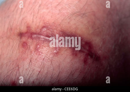 Une cicatrice causée par une lacération sur un genou, montrant les marques de couture interrompue (sutures retirées) Banque D'Images