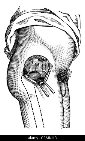 La hanche ouverte par l'extérieur, pour montrer le col du fémur, vintage engraved illustration. Magasin Pittoresque 1875. Banque D'Images