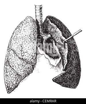 Vieille illustration gravée de poumons humains isolé sur un fond blanc. dictionnaire des mots et des choses - larive et fleury ? 1895 Banque D'Images