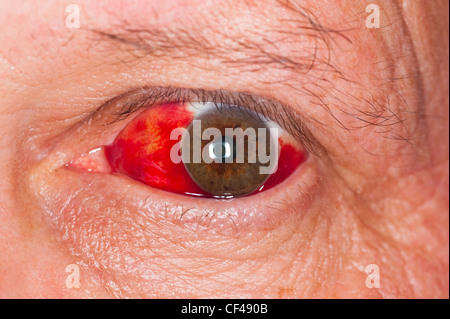 Un homme suffeing avec une hémorragie sous-conjonctivale dans son oeil Banque D'Images