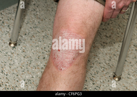 Le psoriasis en plaques sur les genoux d'un homme adulte, 50 ans Banque D'Images