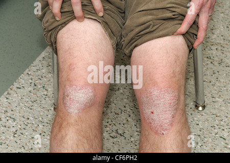 Le psoriasis en plaques sur les genoux d'un homme adulte, 50 ans Banque D'Images