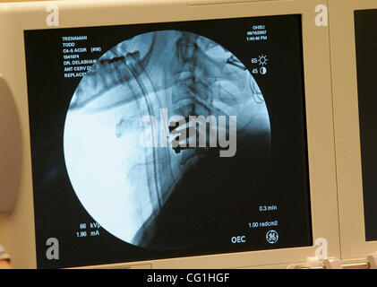 16 août 2007 - Portland, OR, USA - Le disque Cervical Prestige s'affiche sur un moniteur dans le cou du patient Todd Trenaman, de Warren, ou après son opération à l'Oregon Health & Science University Hospital. L'appareil, approuvé par la FDA en juillet, est le premier disque artificiel commercialement disponibles de th Banque D'Images