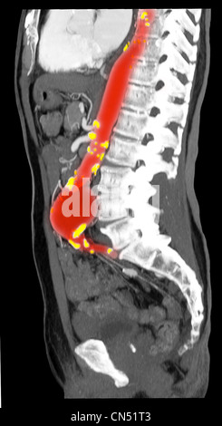 CT scanner des images montrant un anévrisme de l'aorte abdominale Banque D'Images